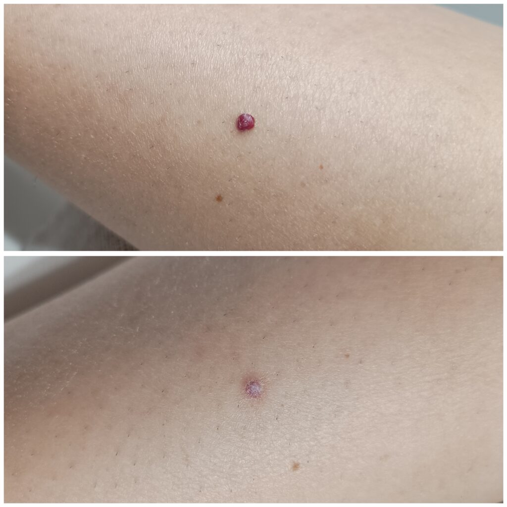 Zamykanie Naczynek  Znamion Rubinowych Bydgoszcz 06